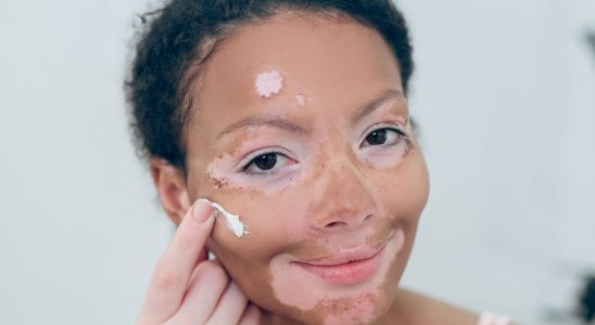 8 questions about Opzelura the new vitiligo treatment authorized in