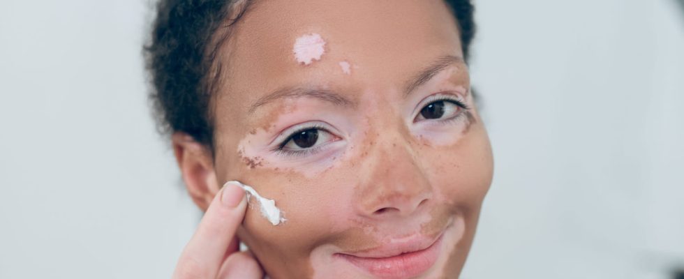 8 questions about Opzelura the new vitiligo treatment authorized in