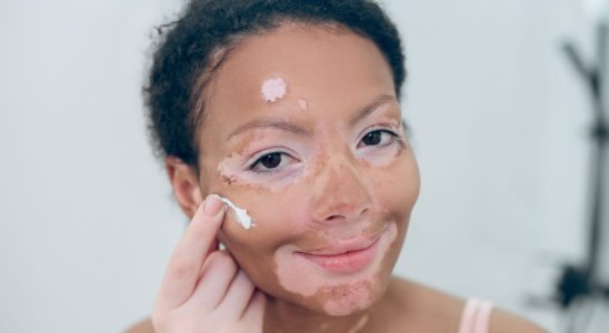 A first vitiligo treatment soon available in France