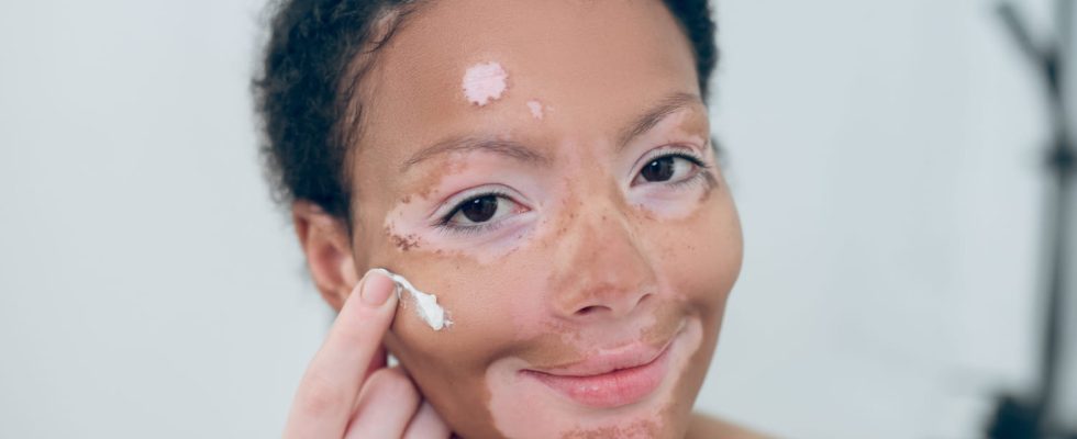 A first vitiligo treatment soon available in France