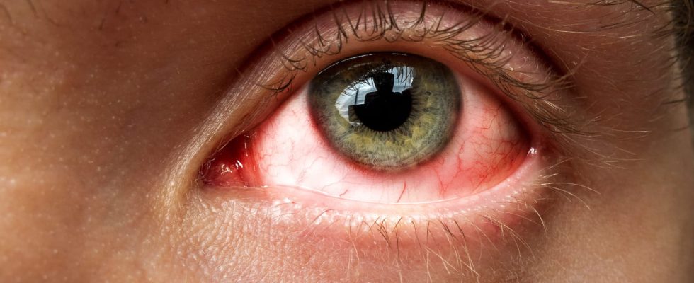 Arcturus new Covid variant symptoms pink eye