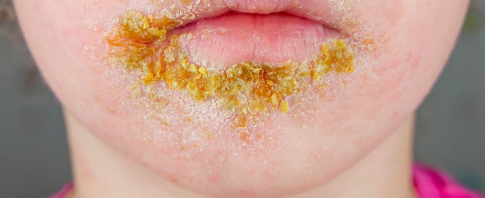 Baby has impetigo causes and treatments to treat it