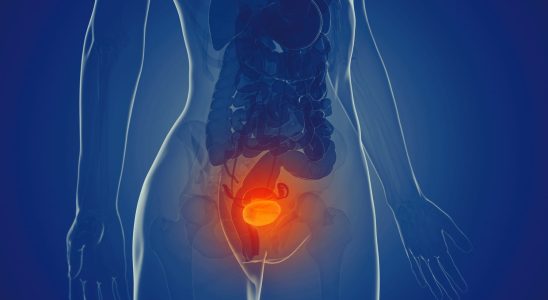 Bladder cancer life expectancy symptoms what is it