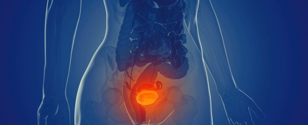 Bladder cancer life expectancy symptoms what is it