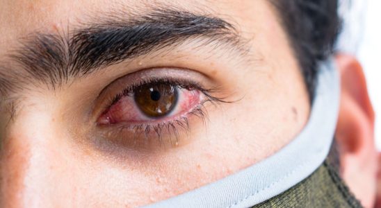 How to differentiate classic conjunctivitis from those due to an