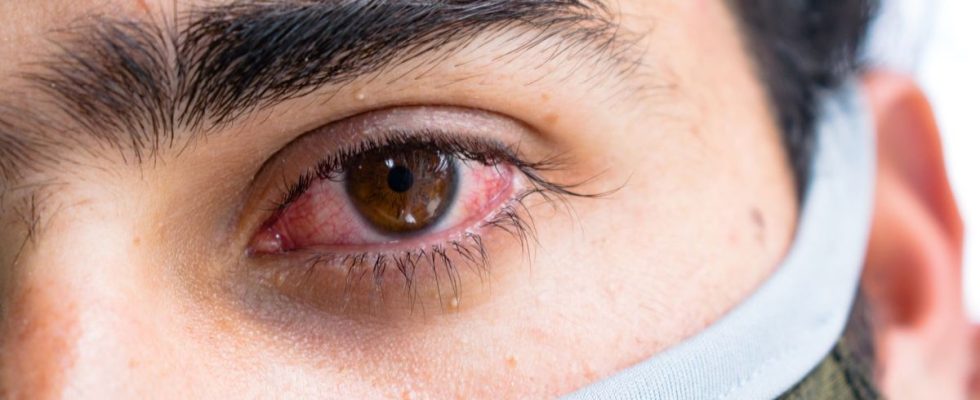 How to differentiate classic conjunctivitis from those due to an