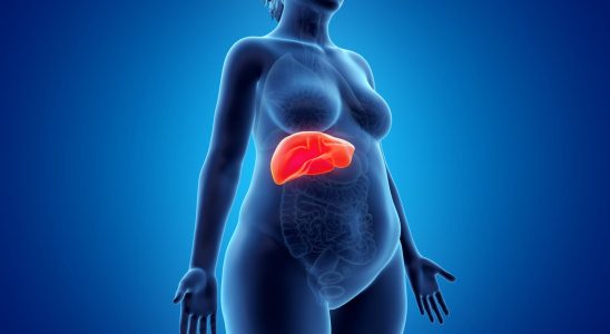 NASH symptom what is fatty liver disease