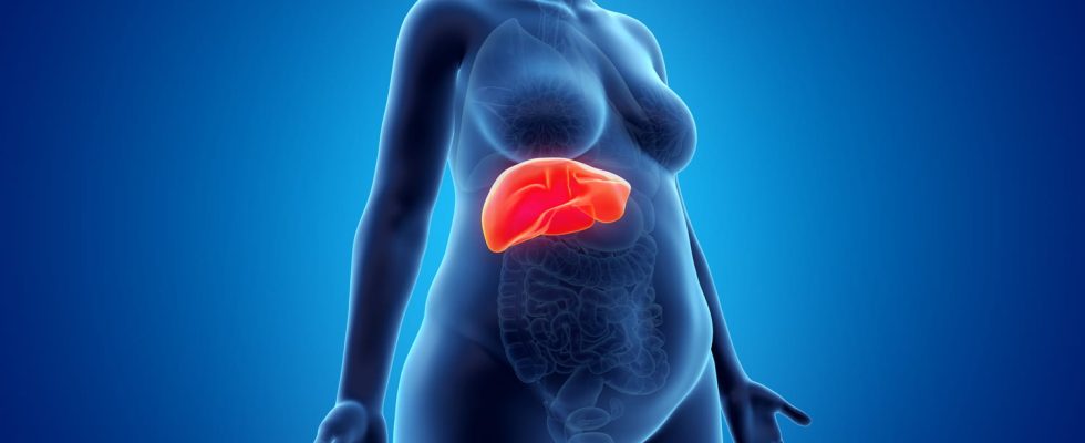 NASH symptom what is fatty liver disease