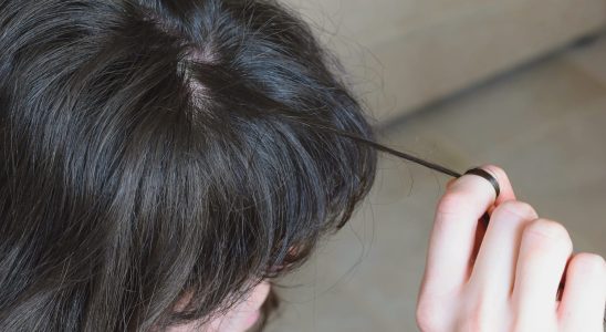 Trichotillomania hair eyelashes causes how to stop