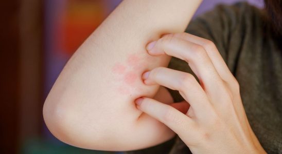 Two first cases of treatment resistant ringworm discovered in New York