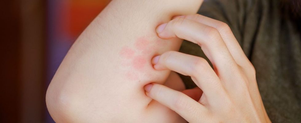 Two first cases of treatment resistant ringworm discovered in New York