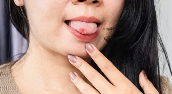 What is an ulceration mouth skin Cancer