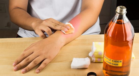 4 natural remedies to relieve a mosquito bite