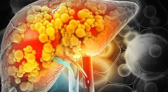 4 signs that your liver has a problem See a