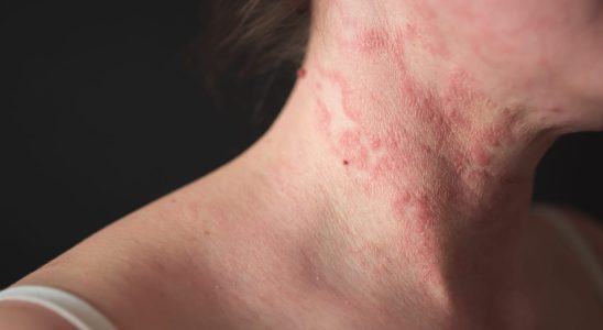 A new skin disease very contagious worries the health authorities