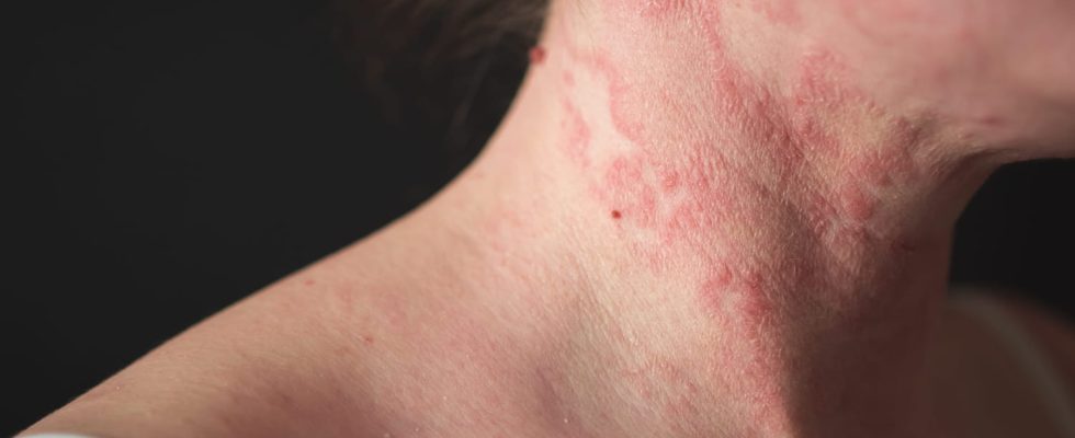 A new skin disease very contagious worries the health authorities