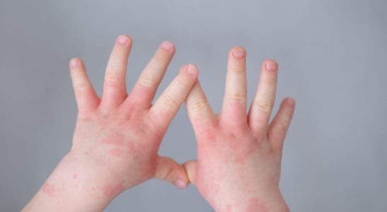 Baby eczema causes treatment creams