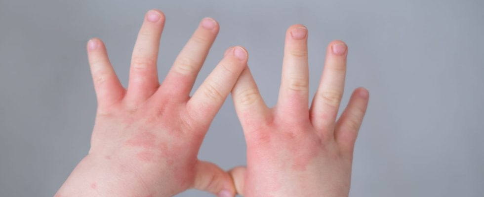 Baby eczema causes treatment creams