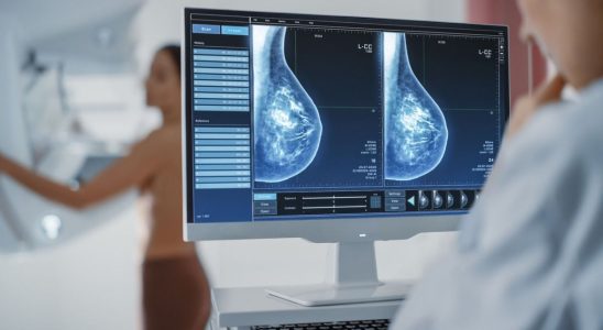 Breast cancer artificial intelligence predicts the disease 5 years before