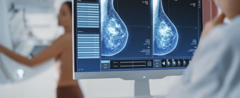 Breast cancer artificial intelligence predicts the disease 5 years before