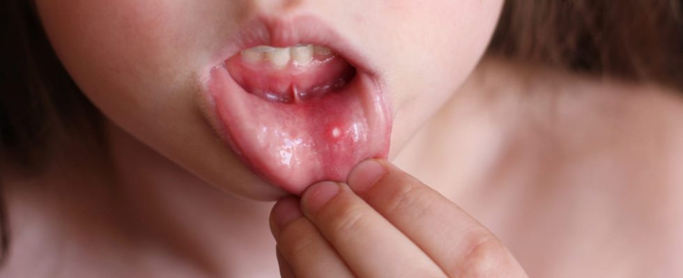 Childhood herpes gingivostomatitis dangers treatment