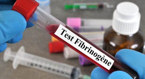 Fibrinogen norm low high what causes