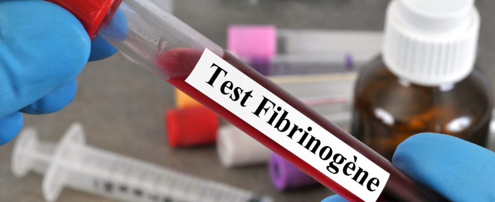 Fibrinogen norm low high what causes