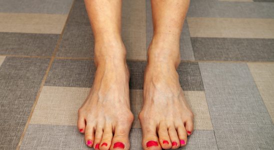 Hallux valgus bunion photo cause when to operate