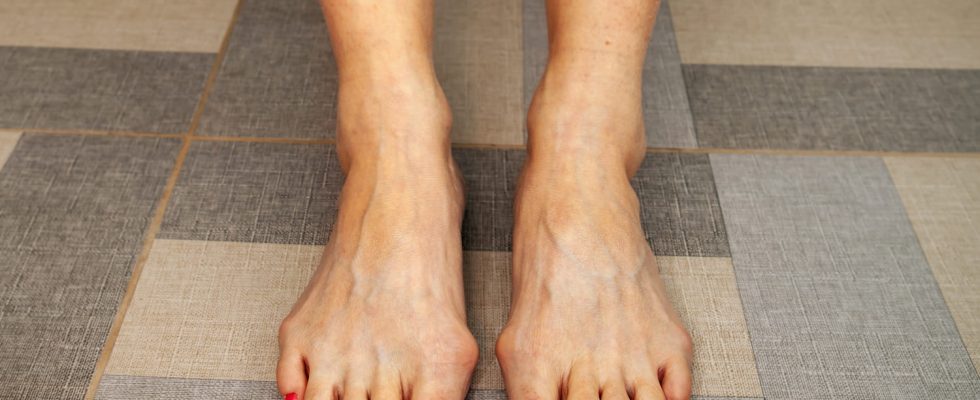 Hallux valgus bunion photo cause when to operate