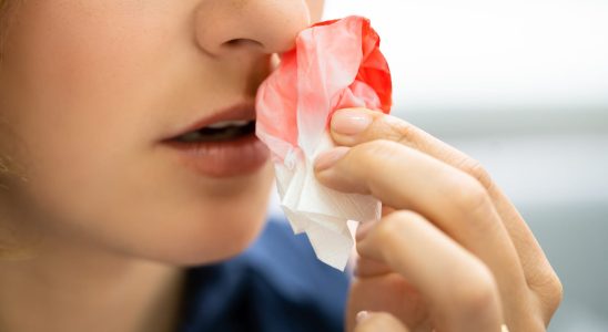 How to stop a nosebleed answer from our emergency doctor