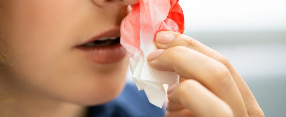 How to stop a nosebleed answer from our emergency doctor