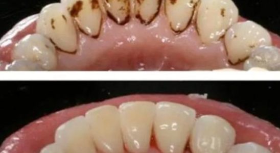 It removes dental tartar without spending any money Natural way