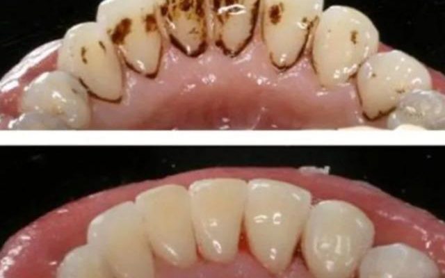 It removes dental tartar without spending any money Natural way