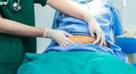 Obesity bariatric surgery reduces the risk of cancer by 50