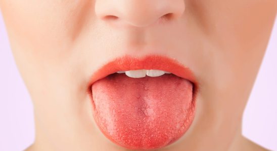 Pimples on the tongue causes photo what to do