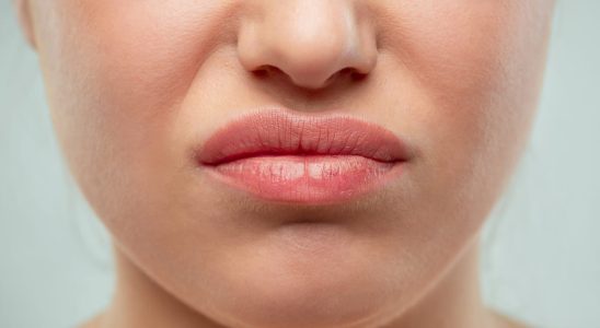 Redness around the nose these solutions can make them disappear