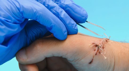 Removal of suture threads duration pain