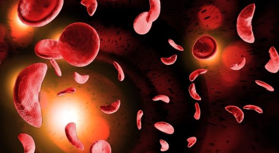 Sickle cell disease the number of cases has increased by