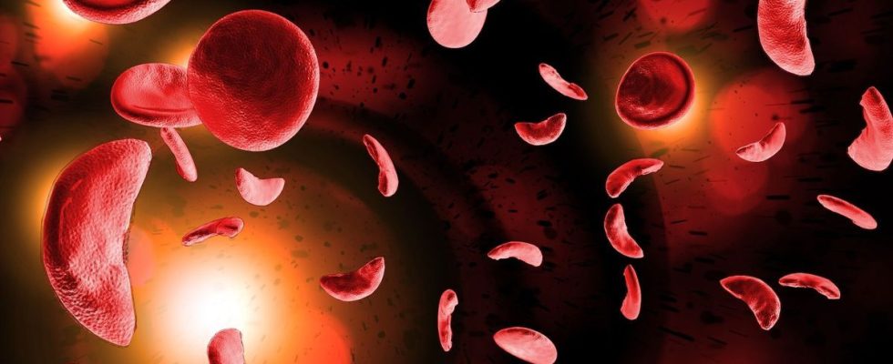 Sickle cell disease the number of cases has increased by