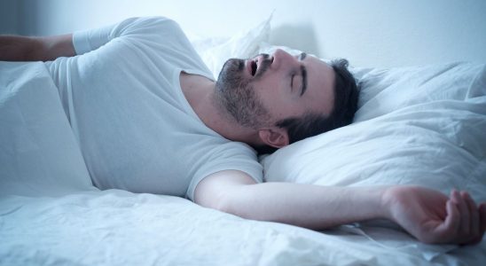 Sleep apnea increases the risk of Alzheimers