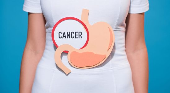 The 5 stages of stomach cancer