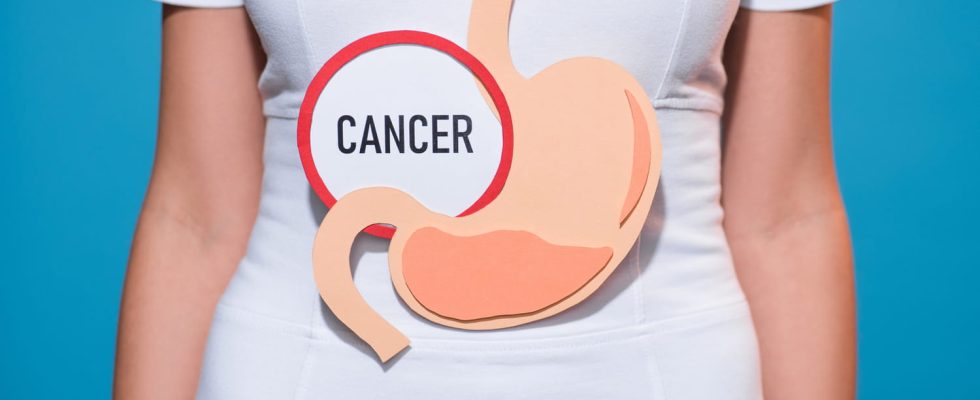 The 5 stages of stomach cancer