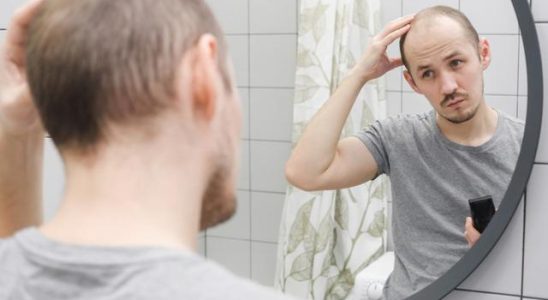 The surprising reason for permanent hair loss If you dont