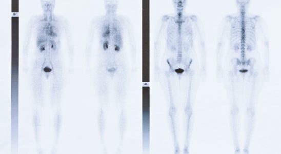 What is a scintigraphy used for Disadvantages and dangers