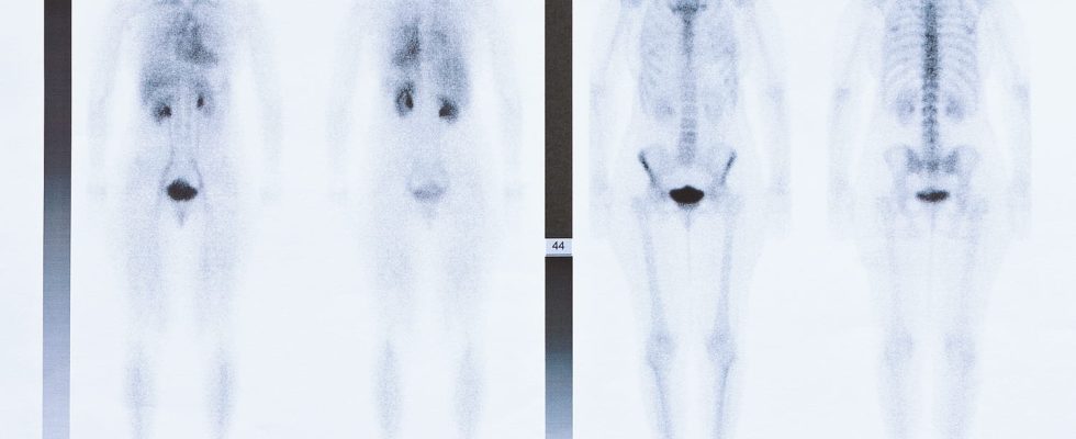 What is a scintigraphy used for Disadvantages and dangers