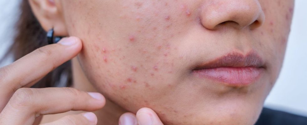 Acne reminder of the precautions to take when taking isotretinoin