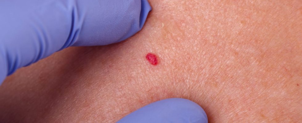 Angioma photo to recognize it treatments