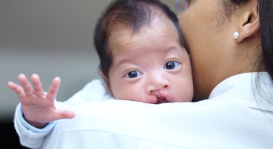 Cleft lip palate definition causes operation