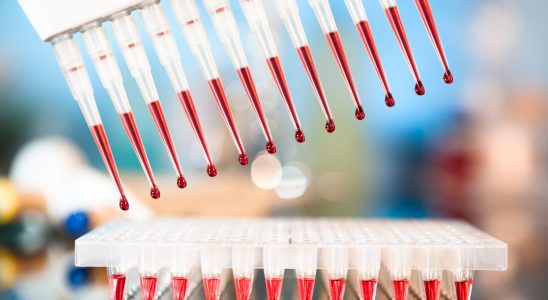 Electrophoresis of plasma proteins diagnosis interpretation