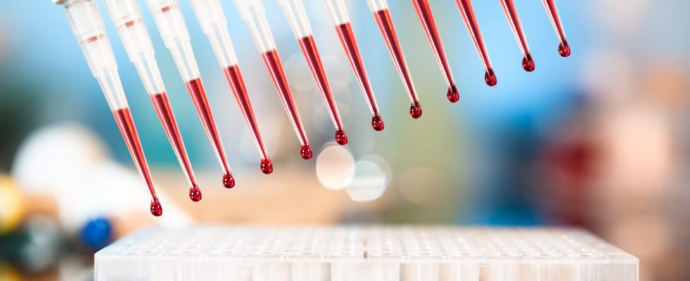 Electrophoresis of plasma proteins diagnosis interpretation